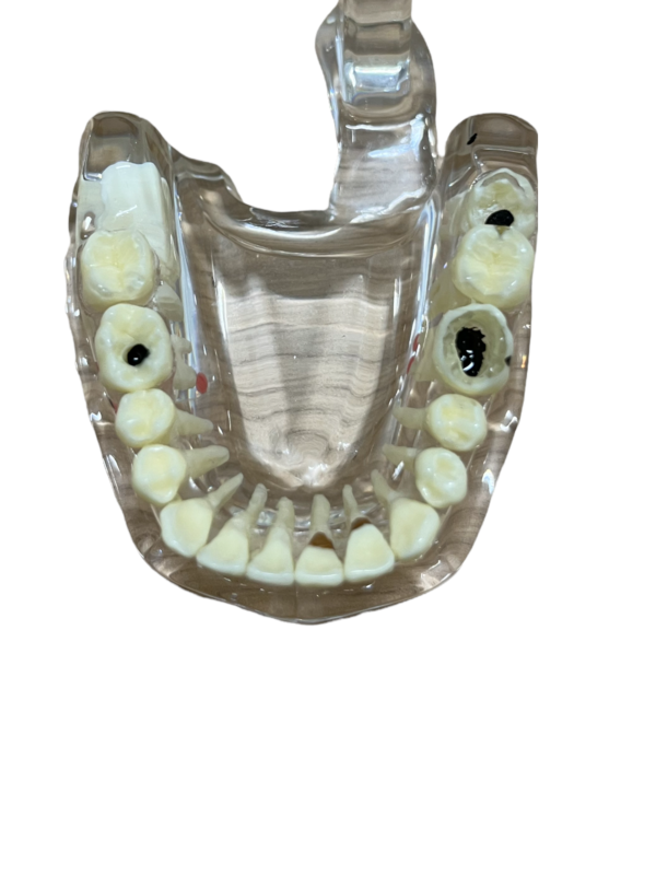 MODELO DE IMPLANTOLOGIA ACRILICO - Imagen 4