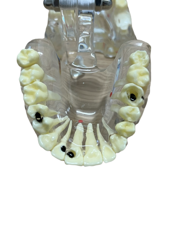 MODELO DE IMPLANTOLOGIA ACRILICO - Imagen 5